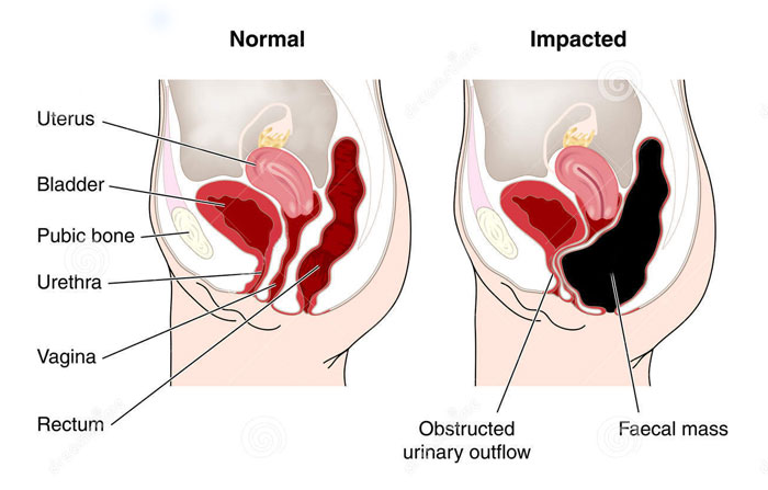 diagram of constipated bowel