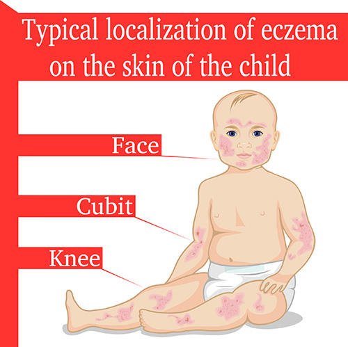 Where is eczema on the body?