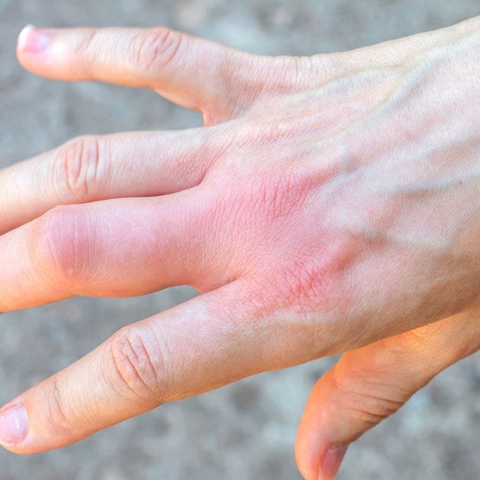 wasp sting on hand