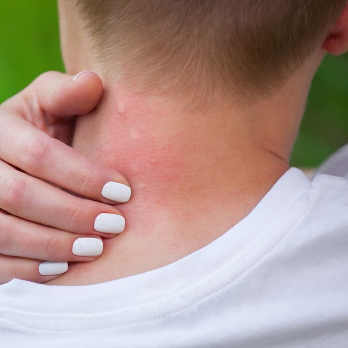 tea tree oil for bug bites