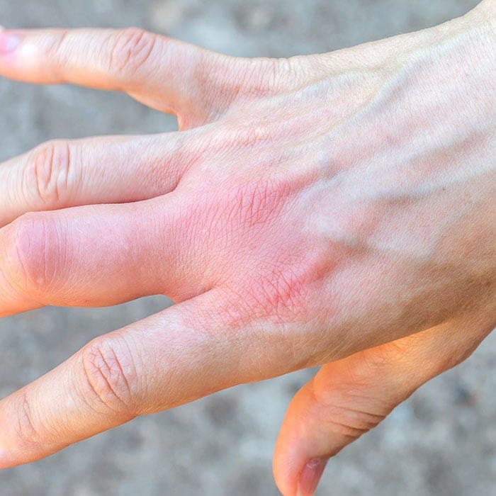 red swollen hand from wasp sting