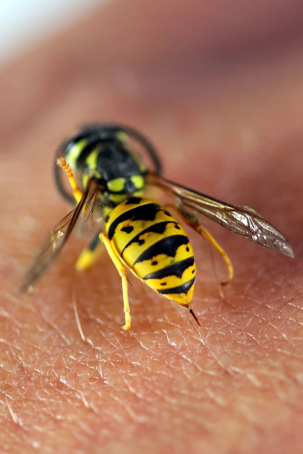 How to Get a Wasp Stinger Out